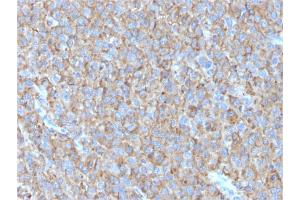 Formalin-fixed, paraffin-embedded human Melanoma stained with CD63 Mouse Monoclonal Antibody (LAMP3/2790) (CD63 抗体  (AA 100-197))