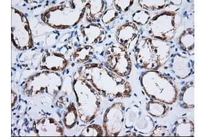 Immunohistochemical staining of paraffin-embedded Carcinoma of Human thyroid tissue using anti-TTC32 mouse monoclonal antibody. (TTC32 抗体)