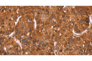 Immunohistochemistry of paraffin-embedded Human liver cancer tissue using HRK Polyclonal Antibody at dilution 1:40 (HRK 抗体)