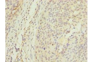 Immunohistochemistry of paraffin-embedded human cervical cancer using ABIN7150355 at dilution of 1:100 (APEX1 抗体  (AA 32-318))