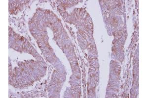 IHC-P Image Immunohistochemical analysis of paraffin-embedded human colon carcinoma, using DPY19L4, antibody at 1:250 dilution. (DPY19L4 抗体  (C-Term))