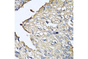 Immunohistochemistry of paraffin-embedded human prostate cancer using ASIP antibody at dilution of 1:100 (40x lens). (ASIP 抗体)