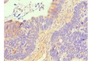 Immunohistochemistry of paraffin-embedded human ovarian cancer using ABIN7170114 at dilution of 1:100 (GLUT1 抗体  (AA 210-310))