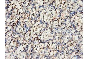 Immunohistochemical staining of paraffin-embedded Carcinoma of Human kidney tissue using anti-CDH2 mouse monoclonal antibody. (N-Cadherin 抗体)
