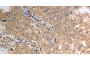 Immunohistochemistry of paraffin-embedded Human ovarian cancer using SLC1A4 Polyclonal Antibody at dilution of 1:70 (SLC1A4 抗体)