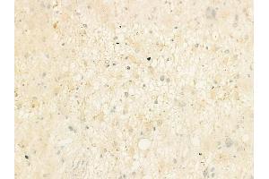 ABIN6264637 and ABIN6273153 at 1/100 staining human astrocytoma by IHC-P. (RAP1B 抗体  (C-Term))