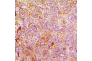 Immunohistochemical analysis of MRPL48 staining in human breast cancer formalin fixed paraffin embedded tissue section. (MRPL48 抗体  (C-Term))