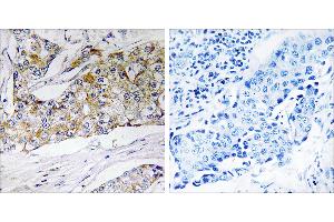 Peptide - +Immunohistochemistry analysis of paraffin-embedded human breast carcinoma tissue using DHRS11 antibody. (DHRS11 抗体)