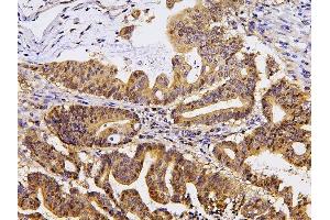 IHC analysis of PPA1 using anti-PPA1 antibody (ABIN6719527). (Pyrophosphatase (Inorganic) 1 (PPA1) (AA 7-236) 抗体)
