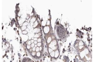 ABIN6267667 at 1/200 staining human colon cancer tissue sections by IHC-P. (CDC37 抗体  (pSer13))