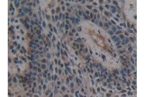 Detection of UBE1L in Human Skin cancer Tissue using Polyclonal Antibody to Ubiquitin Activating Enzyme E1 Like Protein (UBE1L) (ATG7 抗体  (AA 429-488))