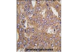 Formalin-fixed and paraffin-embedded human prostata carcinoma tissue reacted with NARS2 antibody (C-term) (ABIN391847 and ABIN2841682) , which was peroxidase-conjugated to the secondary antibody, followed by DAB staining. (NARS2 抗体  (C-Term))