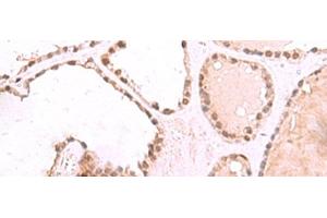 Immunohistochemistry of paraffin-embedded Human thyroid cancer tissue using RUVBL1 Polyclonal Antibody at dilution of 1:85(x200) (RUVBL1 抗体)
