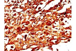 IHC image of ABIN7173988 diluted at 1:300 and staining in paraffin-embedded human melanoma performed on a Leica BondTM system. (TYR 抗体  (AA 19-377))