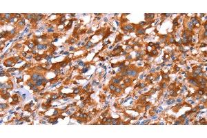 Immunohistochemistry of paraffin-embedded Human thyroid cancer tissue using GAS8 Polyclonal Antibody at dilution 1:40 (GAS8 抗体)