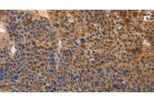 Immunohistochemistry of paraffin-embedded Human liver cancer tissue using MUSK Polyclonal Antibody at dilution of 1:30 (MUSK 抗体)