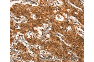 Immunohistochemistry of Human gastic cancer using DEAF1 Polyclonal Antibody at dilution of 1:40 (DEAF1 抗体)