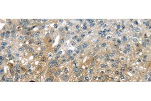 Immunohistochemistry of paraffin-embedded Human breast cancer using UPP2 Polyclonal Antibody at dilution of 1/35 (UPP2 抗体)