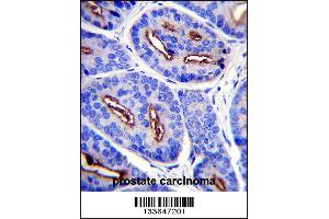 FOLH1 Antibody immunohistochemistry analysis in formalin fixed and paraffin embedded human prostate carcinoma followed by peroxidase conjugation of the secondary antibody and DAB staining. (PSMA 抗体  (N-Term))