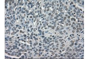 Immunohistochemical staining of paraffin-embedded Adenocarcinoma of breast tissue using anti-LDHA mouse monoclonal antibody. (Lactate Dehydrogenase A 抗体)