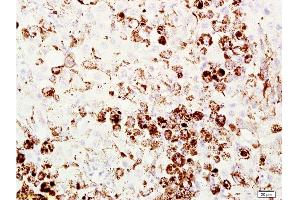 Formalin-fixed and paraffin embedded mouse melanoma labeled with Anti-Melanoma HMB45/Melanoma/Melan-A/MART-1 Polyclonal Antibody, Unconjugated  at 1:200 followed by conjugation to the secondary antibody and DAB staining. (MLANA 抗体  (AA 51-118))