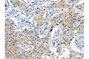 The image on the left is immunohistochemistry of paraffin-embedded Human lung cancer tissue using ABIN7190319(CNTNAP3 Antibody) at dilution 1/40, on the right is treated with synthetic peptide. (CNTNAP3 抗体)