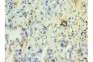 Immunohistochemistry of paraffin-embedded human lung cancer using ABIN7161904 at dilution of 1:100 (TR4 抗体  (AA 240-380))