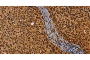 Immunohistochemistry of paraffin-embedded Human cervical cancer using CEL Polyclonal Antibody at dilution of 1:40 (Cholesterol Esterase 抗体)