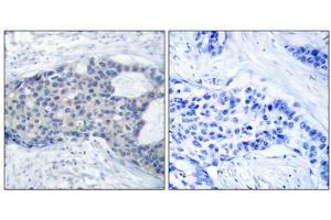 Immunohistochemical analysis of paraffin-embedded human breast carcinoma tissue using Zap-70(Phospho-Tyr493) Antibody(left) or the same antibody preincubated with blocking peptide(right). (ZAP7 (pTyr493) 抗体)