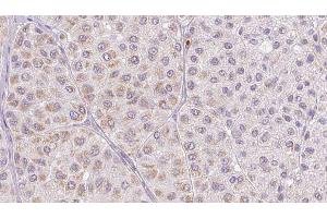 ABIN6277683 at 1/100 staining Human melanoma tissue by IHC-P. (PLAT 抗体  (C-Term))