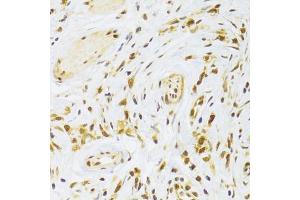 Immunohistochemistry of paraffin-embedded human gastric cancer using RPL13 Antibody (ABIN2559760) at dilution of 1:100 (40x lens). (RPL13 抗体)