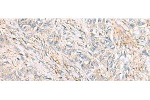 Immunohistochemistry of paraffin-embedded Human ovarian cancer tissue using HBZ Polyclonal Antibody at dilution of 1:120(x200) (HBZ 抗体)