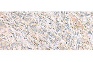 Immunohistochemistry of paraffin-embedded Human ovarian cancer tissue using HBZ Polyclonal Antibody at dilution of 1:120(x200) (HBZ 抗体)