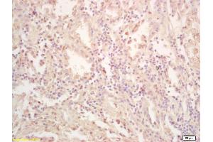 Formalin-fixed and paraffin embedded human gastric carcinoma labeled with Rabbit Anti FES Polyclonal Antibody, Unconjugated (ABIN714191) at 1:200 followed by conjugation to the secondary antibody and DAB staining (FES 抗体  (AA 121-220))