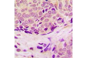 Immunohistochemical analysis of RPL37 staining in human breast cancer formalin fixed paraffin embedded tissue section. (RPL37 抗体  (Center))