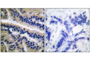 Immunohistochemical analysis of paraffin-embedded human lung carcinoma tissue, using Caspase 9 (cleaved-Asp353) antibody. (Caspase 9 抗体  (Cleaved-Asp353))