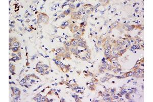 Formalin-fixed and paraffin embedded human breast carcinoma labeled with Anti-ZNF703 Polyclonal Antibody, Unconjugated  at 1:500 followed by conjugation to the secondary antibody and DAB staining. (ZNF703 抗体  (AA 221-320))