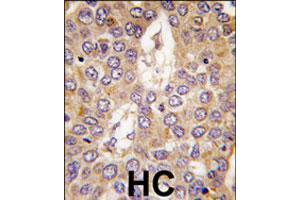 Formalin-fixed and paraffin-embedded human hepatocellular carcinoma reacted with CSNK1G2 polyclonal antibody  , which was peroxidase-conjugated to the secondary antibody, followed by DAB staining. (Casein Kinase 1 gamma 2 抗体  (C-Term))
