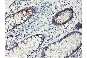 Immunohistochemical staining of paraffin-embedded Human colon tissue using anti-FABP2 mouse monoclonal antibody. (FABP2 抗体)