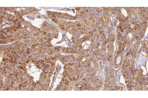 ABIN6267112 at 1/100 staining Human thyroid cancer tissue by IHC-P. (Doublecortin 抗体  (pSer297))