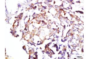 Formalin-fixed and paraffin embedded human lung cancer labeled with Rabbit Anti-BDKRB1 Polyclonal Antibody, Unconjugated  at 1:200 followed by conjugation to the secondary antibody and DAB staining (BDKRB1 抗体  (AA 161-260))