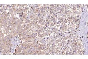 ABIN6273319 at 1/100 staining Human thyroid cancer tissue by IHC-P. (SLC13A2 抗体)