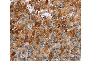 Immunohistochemistry of Human thyroid cancer using CCR9 Polyclonal Antibody at dilution of 1:40 (CCR9 抗体)