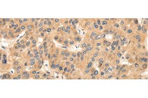 Immunohistochemistry of paraffin-embedded Human liver cancer using TTC23 Polyclonal Antibody at dilution of 1/35 (TTC23 抗体)