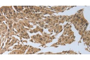 Immunohistochemistry of paraffin-embedded Human cervical cancer using PSMD6 Polyclonal Antibody at dilution of 1:40