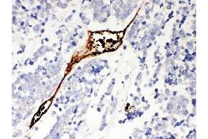 IHC-P: Mesothelin antibody testing of human lung cancer tissue (Mesothelin 抗体  (AA 306-576))