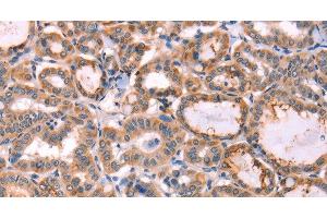 Immunohistochemistry of paraffin-embedded Human thyroid cancer tissue using PROS1 Polyclonal Antibody at dilution 1:60 (PROS1 抗体)