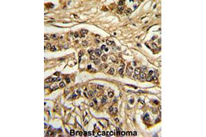 Formalin-fixed and paraffin-embedded human breast carcinomareacted with FREQ polyclonal antibody , which was peroxidase-conjugated to the secondary antibody, followed by AEC staining. (NCS1 抗体  (Internal Region))