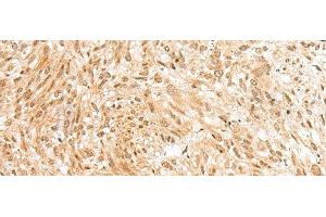 Immunohistochemistry of paraffin-embedded Human liver cancer tissue using RBM19 Polyclonal Antibody at dilution of 1:45(x200) (RBM19 抗体)