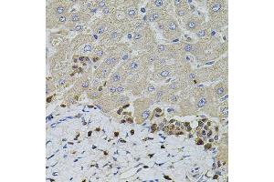 Immunohistochemistry of paraffin-embedded human liver injury using S100A12 antibody (ABIN1876516) at dilution of 1:100 (40x lens). (S100A12 抗体)